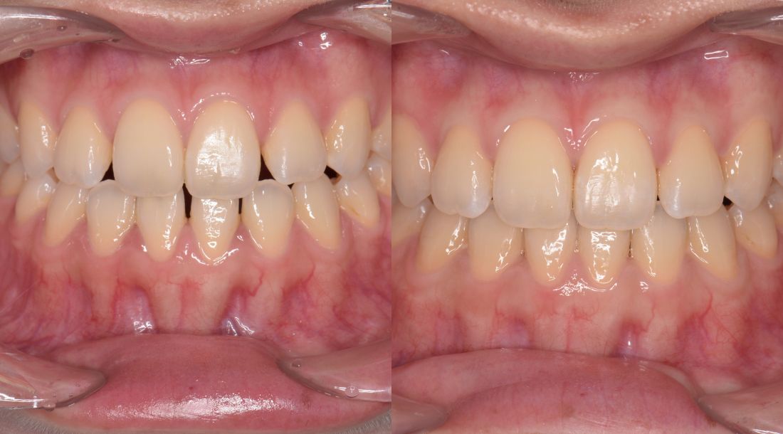 歯の隙間が気になる方の矯正