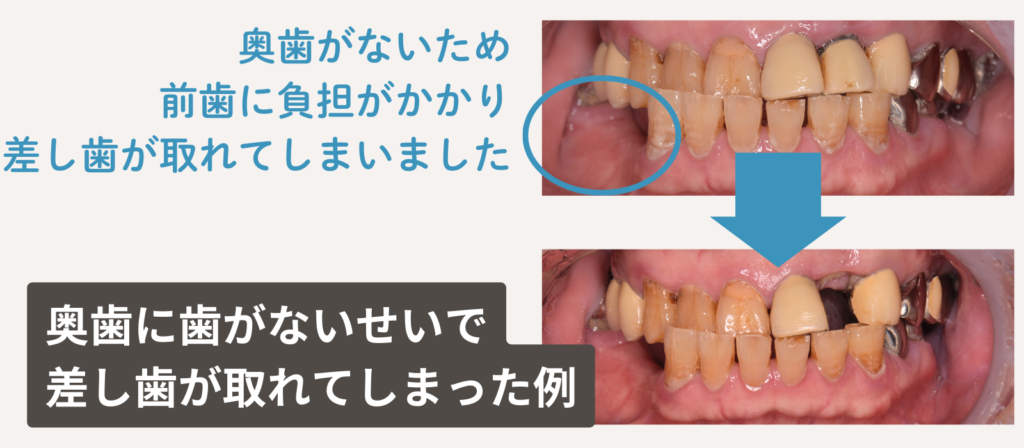 奥歯に歯がないせいで差し歯が取れてしまった例の写真です。奥歯がないため前歯に負担がかかり、差し歯が取れてしまいました。