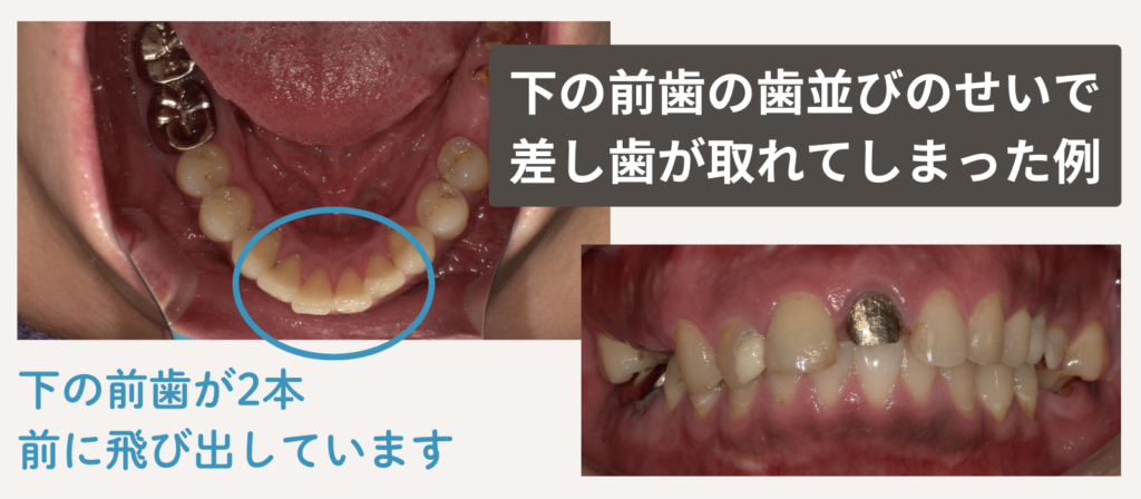 下の前歯の歯並びのせいで差し歯が取れてしまった例を写真で載せています。下の前歯が2本、隣の歯よりも前に飛び出しています。